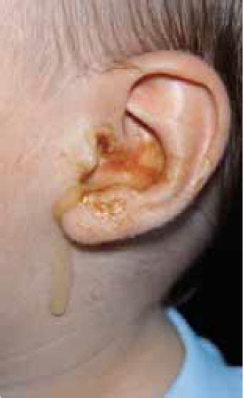 Outer And Middle Ear Problems The Pharmaceutical Journal