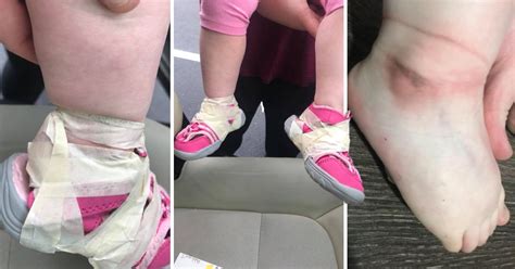 mum horrified after daughter s shoes were taped onto her feet by nursery metro news