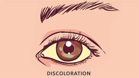 Raccoon Eyes Condition Its Symptoms Causes Complications And More