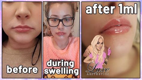 Natural Lip Filler Experience Ml Before And After Lip Injections