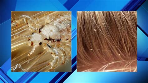 How To Prevent And Treat Head Lice Youtube