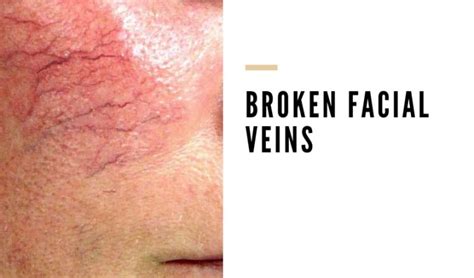 How To Get Rid Of Broken Blood Vessels On Face Vein Solutions