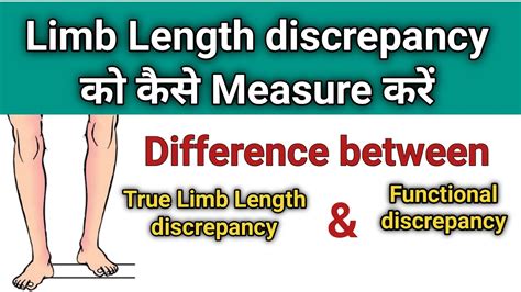 How To Measure Limb Length Discrepancy Leg Length Test Limb Length