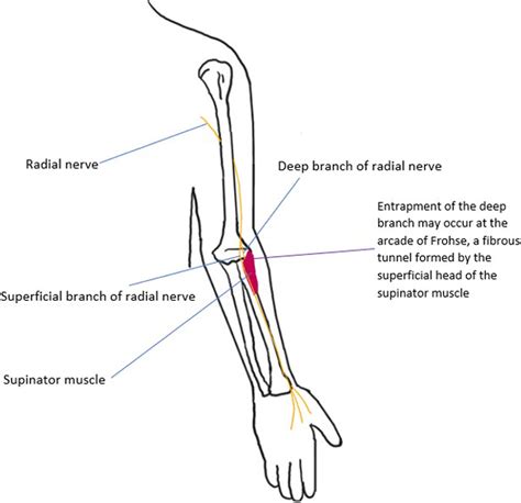 Entrapment Of The Radial Nerve Pacs