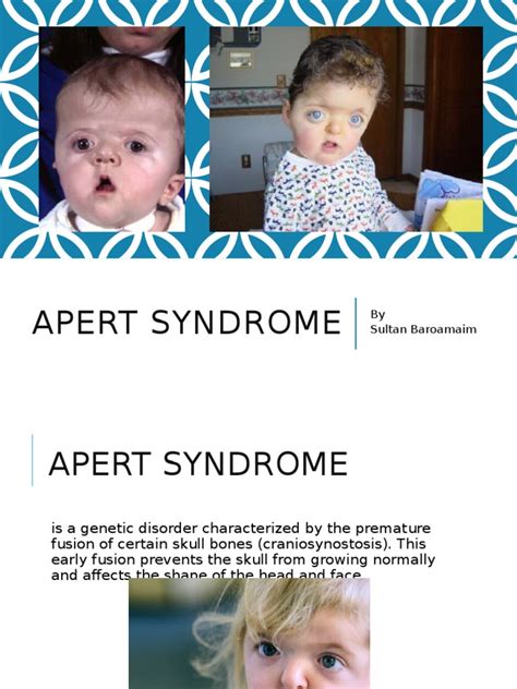 apert syndrome