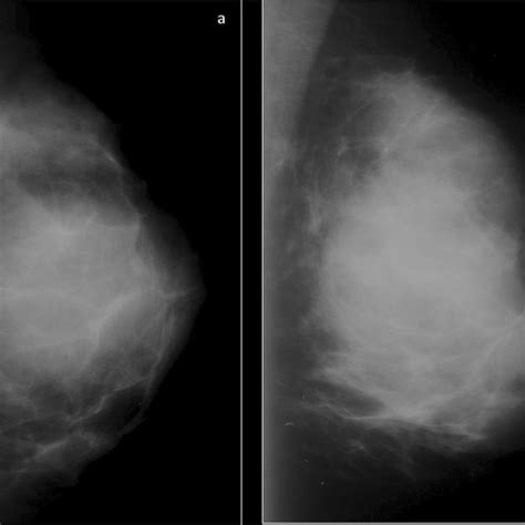 Mammographic Findings Of A Diffuse Large B Cell Lymphoma In A 48 Year