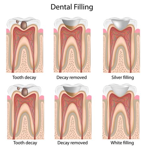 Dental Fillings Amalgam And Composite Ac Dentistry
