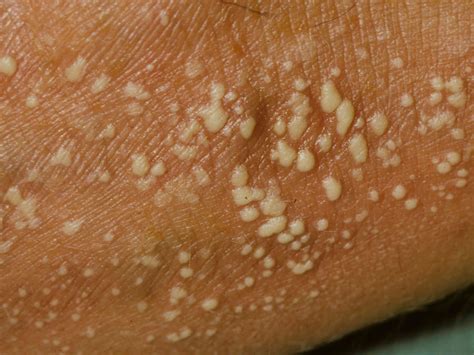Psoriasis Symptoms Types And Images