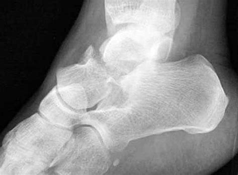 The Diagnosis Management And Complications Associated With Fractures