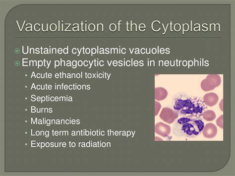 Reactive Atypical Abnormal Morphology Of Neutrophils