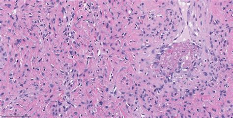 Pathology Outlines Nasopharyngeal Angiofibroma