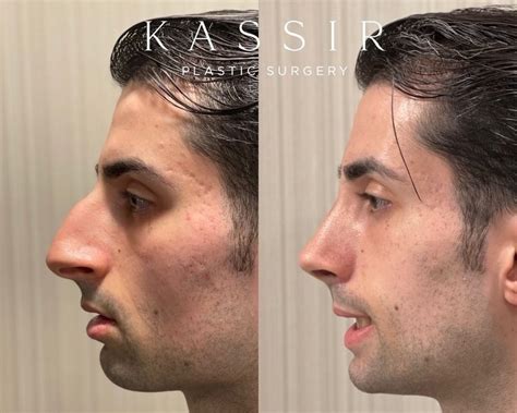 Male Rhinoplasty Before And After — Kassir Plastic Surgery In Ny And Nj