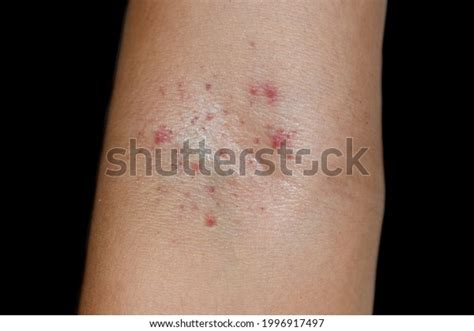 Group Small Red Spots Petechiae Cubital Stock Photo Edit Now 1996917497