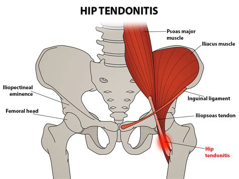 Anterior Iliopsoas Impingement And Tendinitis After Total Hip My Xxx Hot Girl