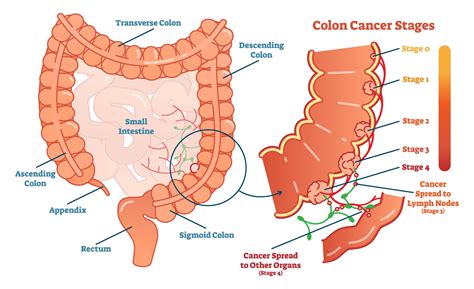 Colon And Rectal Cancer Colorectal Cancer Treatment Alaska Surgical Oncology Alaska Breast