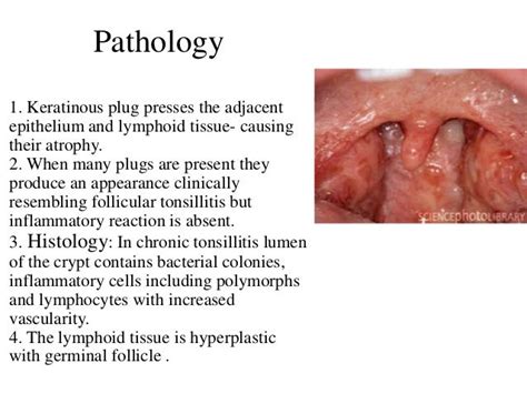 Tonsillitis