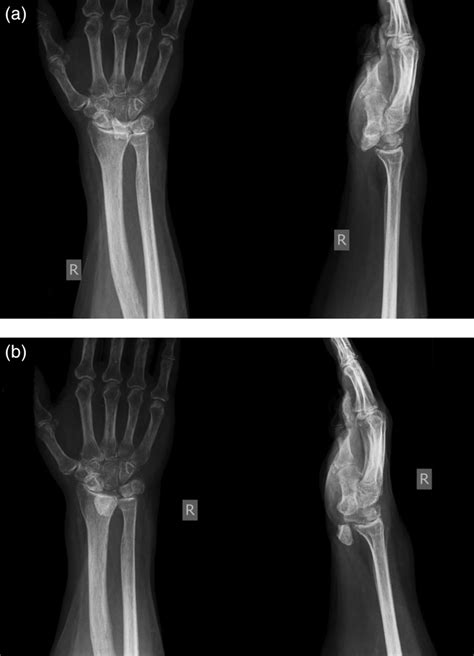 Initially Unrecognised Lunate Dislocation As A Cause Of