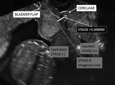 Location Of The Laparoscopic Transabdominal Cerclage The Vesico Uterine Fold As An Ultrasound