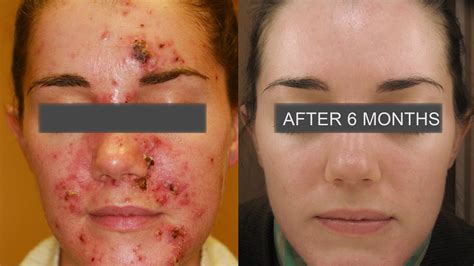 Learn How To Treat Severe Acne By Dr Franziska Ringpfeil Board