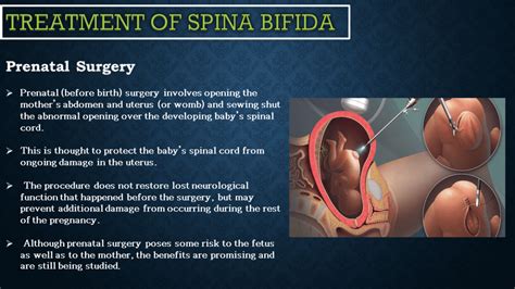 Neurological Disorder Spina Bifida Pictures Neurohealth