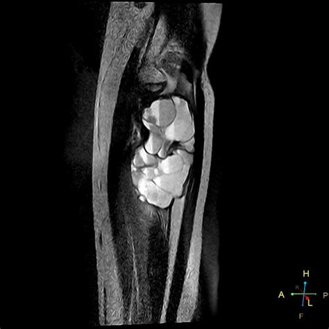 Aneurysmal Bone Cyst Image