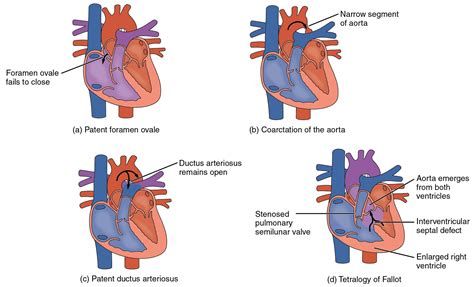 Congenital Heart Defects Pediatrics Pinterest Congenital Heart