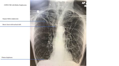 Emphysema What You Need To Know Ems Airway
