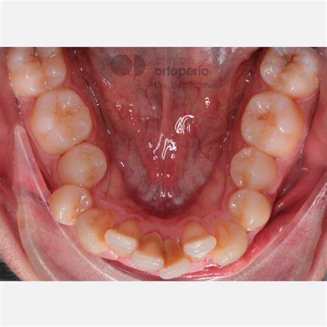 Apiñamiento Dental Severo Tratamiento De Ortodoncia Sin Extracciones