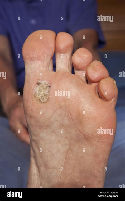 Plantar Wart Bottom Of Foot Telegraph