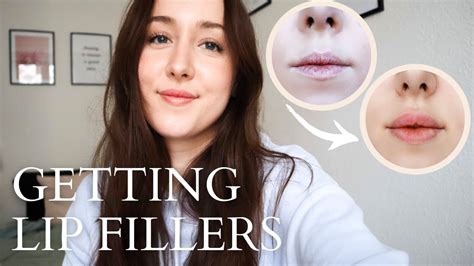 Getting LIP FILLERS For The First Time Before After YouTube