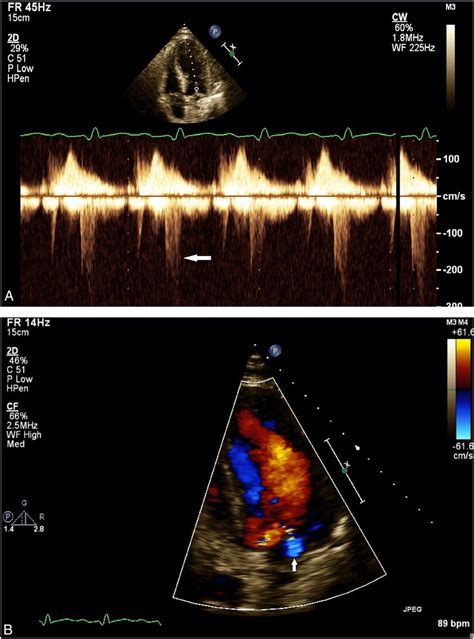 Diastolic Mitral Regurgitation In A Patient With Coronary Artery