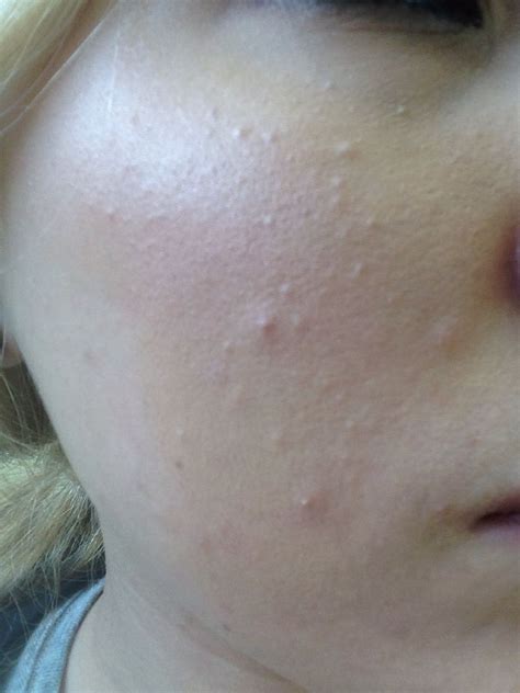 Please Help Bumps All Over My Faceare These Clogged Pores Pics