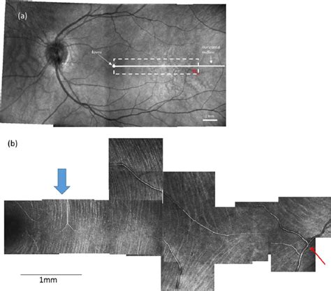 A Wide Field Fundus Mosaic And An Aoslo Raphe Montage From The Same