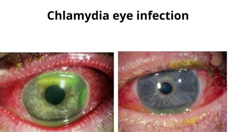 Pin By Moxiber On Chlamydia Infection Symptoms Infections