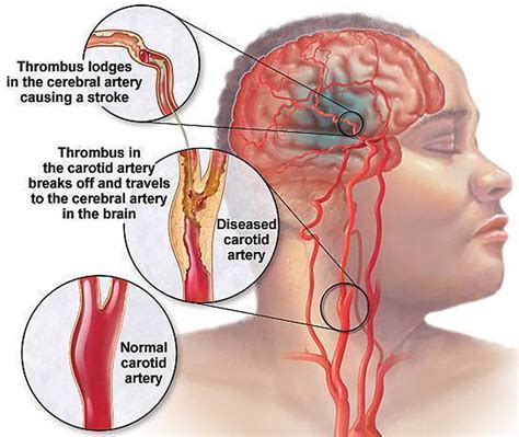 Carotid Artery Disease Stenosis Carotid Artery Dissection