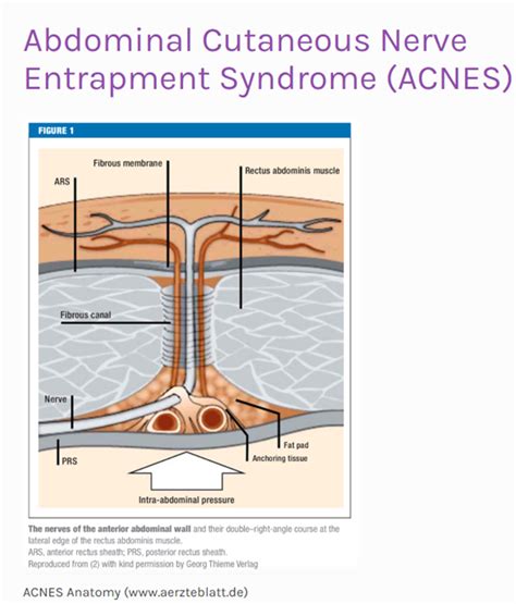 2 1 피부과가 아닌 통증의학과를 가야하는 acnes abdominal cutaneous nerve entrapment syndrome 복부 피부 신경 포착 증후군을