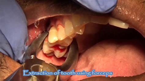 Extraction Of Carious Upper Molar Tooth With Periapical Infection Youtube