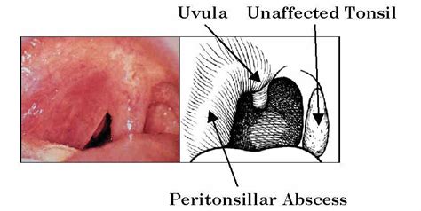 Peritonsillar Abscess Causes Symptoms Treatment