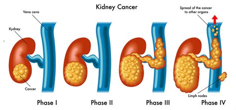 Survival Rates For Kidney Cancer Know From Urologist In Mumbai