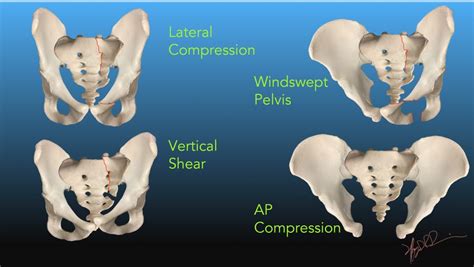Pelvic Fractures Uw Emergency Radiology