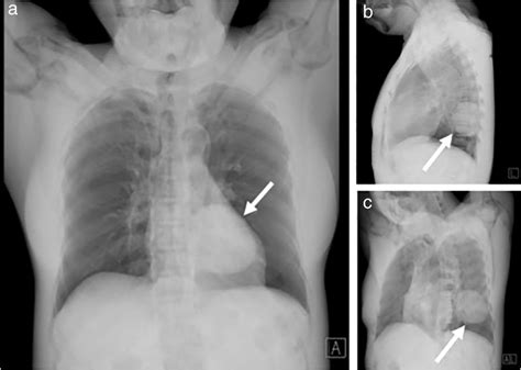 Oblique Views Of Chest Radiography From A Designed Rotation Angle