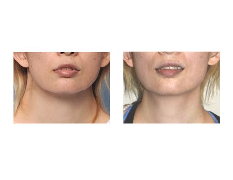 Webbed Neck Surgery Results Dr Barry Eppley Indianapolis Explore