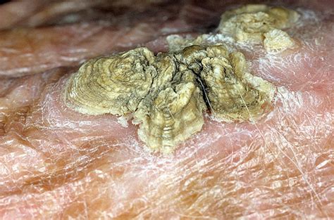 Skin Cancer On Hands Pictures 16 Photos And Images