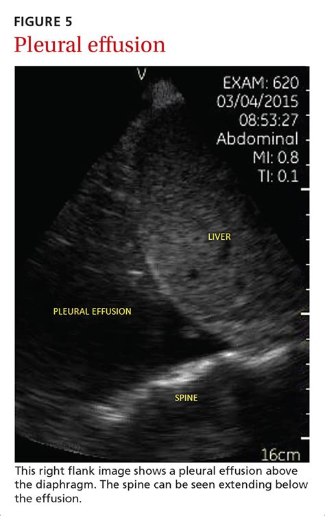 Right Pleural Effusion Ultrasound