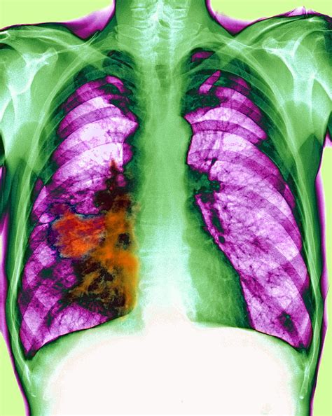 Lung Cancer X Ray Photograph By Du Cane Medical Imaging Ltd Fine Art