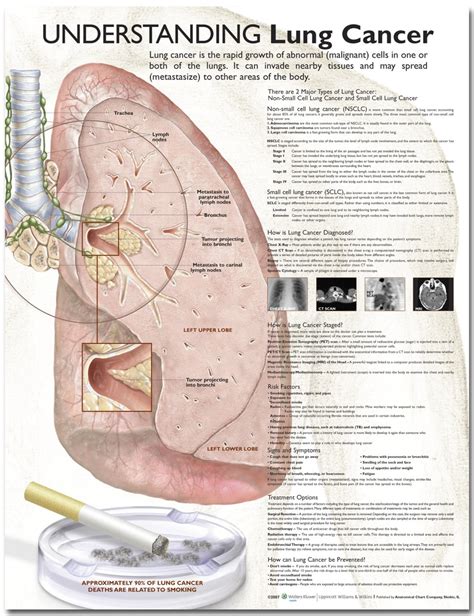 A cough that will not go away, and gets worse over time. Understanding Lung Cancer Poster | Lung Cancer Anatomical ...