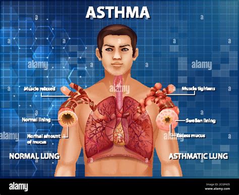 Human Anatomy Asthma Diagram Illustration Stock Vector Image And Art Alamy