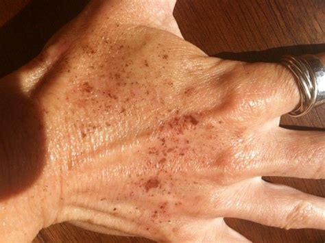 The 25 Best Brown Spots On Hands Ideas On Pinterest Simple Chopped