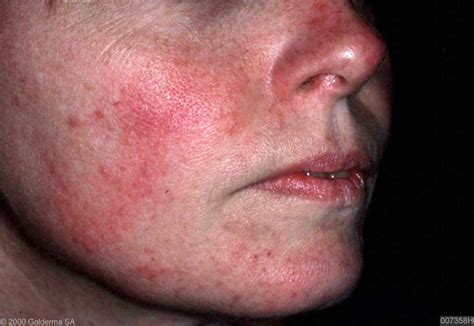 Acne Rosacea Home Remedy And Other Natural Treatments