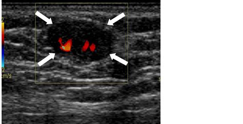Fibroadenoma Of The Ectopic Axillary Breast Tissue Sonographic Appearances